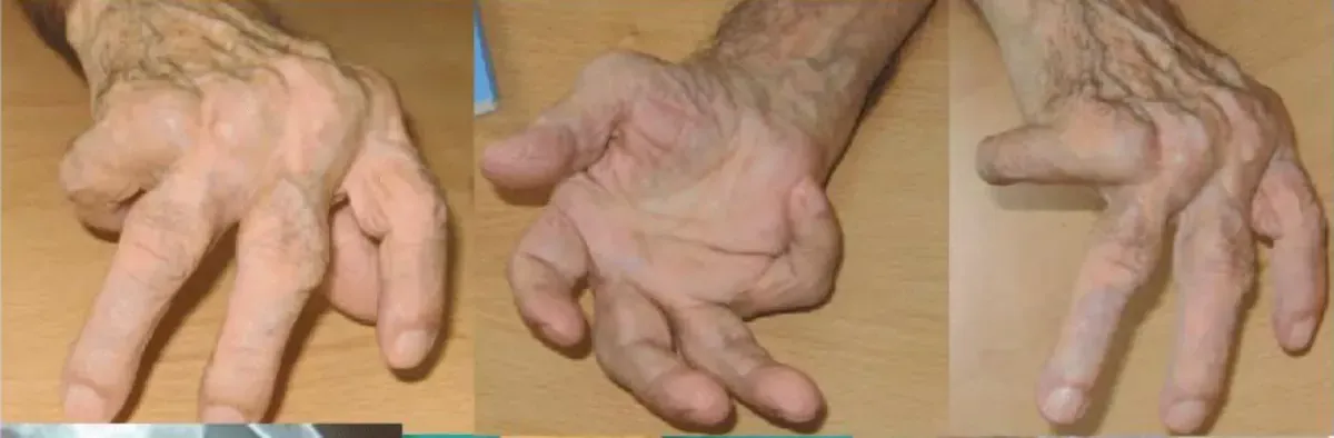 Röntgen Knie — degenerative Veränderungen