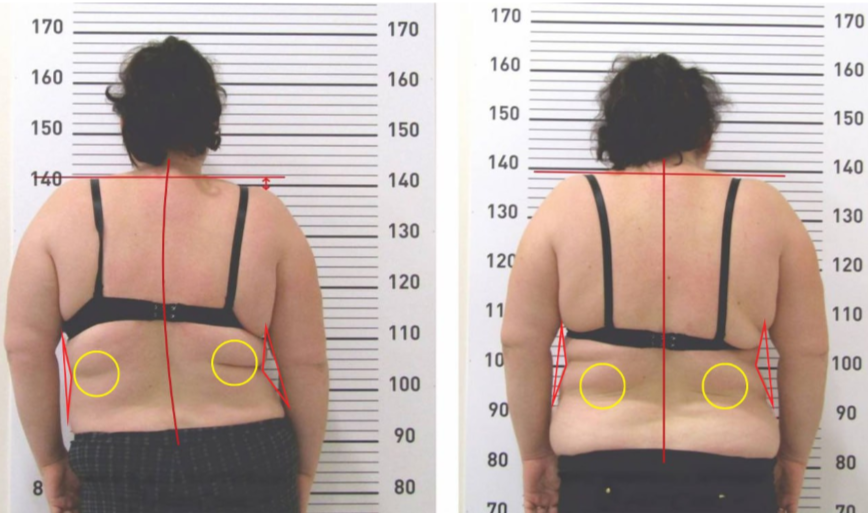 Patientin 62 Jahre — Wirbelsäule vorher und nachher