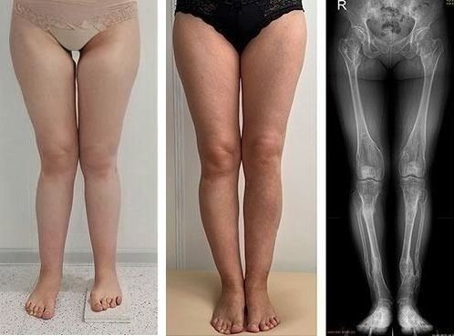 Patientin 44 Jahre — Knie vorher/nachher und Röntgen