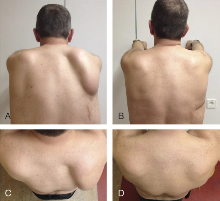 Mann 37 Jahre — Haltungskorrektur, Vorher/Nachher-Serie