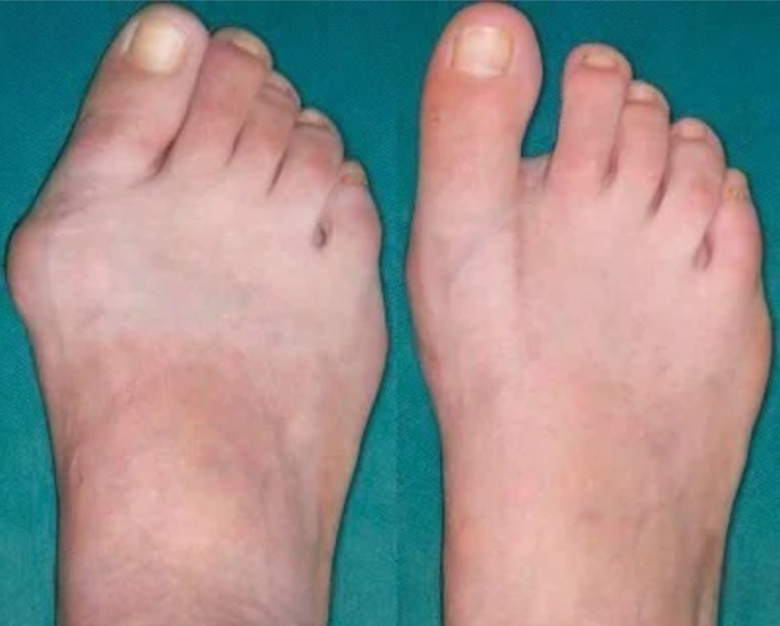 Mann 69 Jahre — Zehenarthrose vorher und nachher