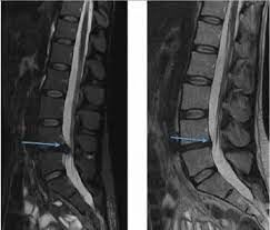 Röntgen/MRT Wirbelsäule – degenerative Veränderungen