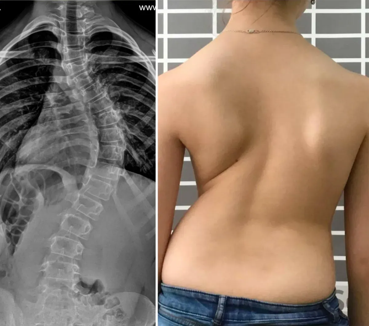 Witwenbuckel — Wirbeldeformation